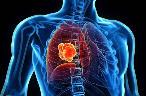 另外，研究发现，巴豆醛和丙烯醛对呼吸道黏膜有强烈刺激，长期接触可导致鼻炎、咽喉炎、气管炎等炎症疾病。当前，一些不吸烟的中老年家庭主妇成为肺癌的高发人群，有研究认为，或和吸入油烟有关。因此，刘前桂提醒，老年朋友一定要注意烹饪时减少油烟。